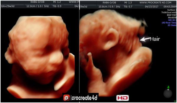 Actual Hair HD ultrasound. 29 weeks 3 days