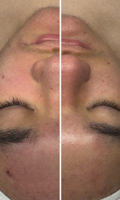 B&A teen facial