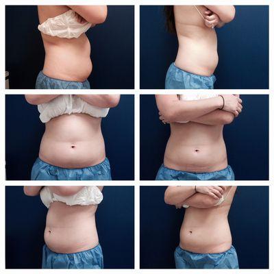 Another beautiful result from just 3 cycles of Coolsculpting!