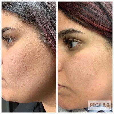 Before/after microneedling on scarring