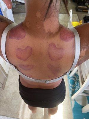 after my cupping