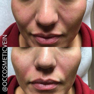 2 Syringes of Restylane Contour. 1 injected in Nasolabial Fold the other in the cheeks.