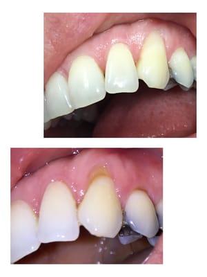 Facial Abrasion Before and After