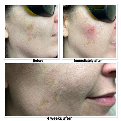 Dark / Age Spots Laser Treatment