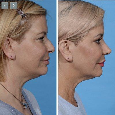 Rhinoplasty