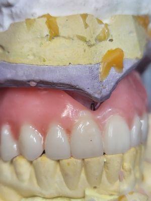 Full denture set -up