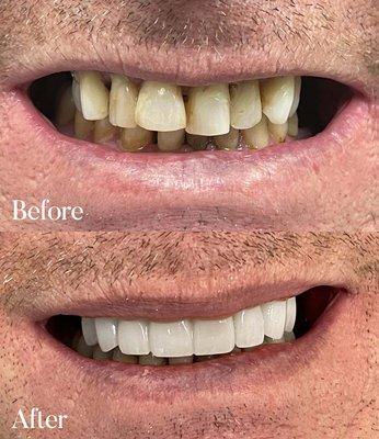 Our Patient was not happy with his uneven, yellow smile. Dr. Kashani gave him the dream smile with Porcelain veneers!