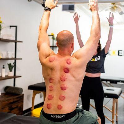 Best cupping for back pain