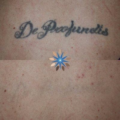 Laser Tattoo Removal