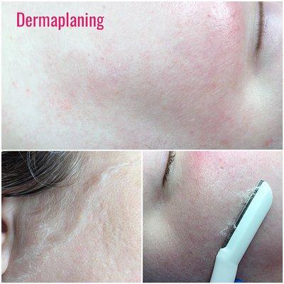 Dermplaning