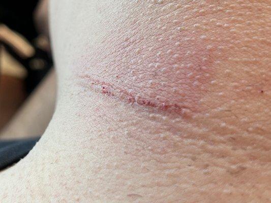 A cut from a "new razor"