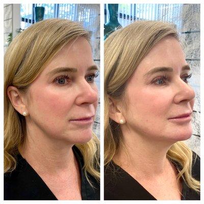 Dermal filler in the chin and jaw for a smooth and lifted look!