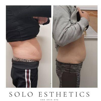 Cryo Body Contouring