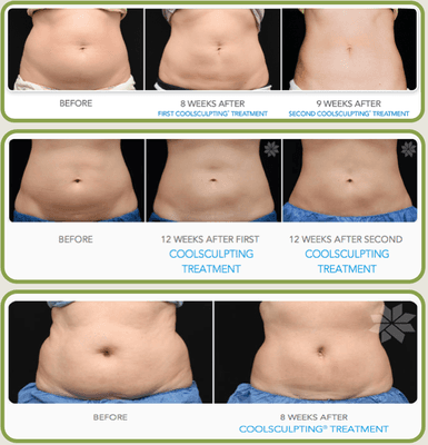 CoolSculpting Freeze your fat away!