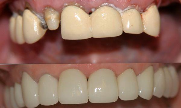 Full mouth reconstruction! Implants in the molar areas+replacement of porc.fused to metal crowns & bridges w/ all porcelain restorations