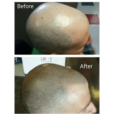 Scalp Micropigmentation hair restoration in Salt Lake City, Utah.