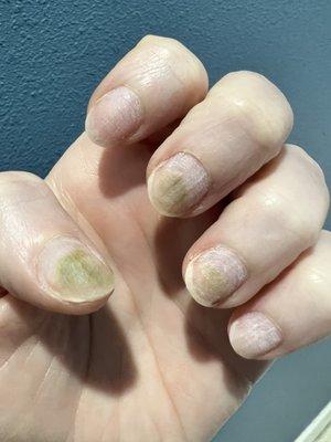 Nail Fungus from a bad nail job!