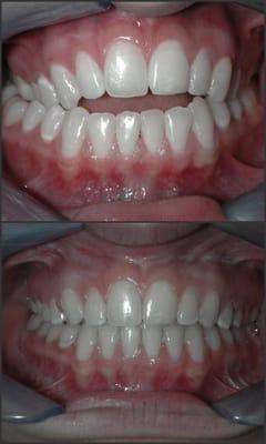 Before and After orthodontic treatment with Dr. Russell  (2 years)