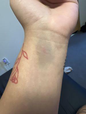 Bruised wrist from trying to stick the needle to my vein.