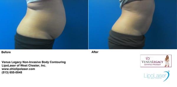 Venus Legacy is your best option for non-invasive fat reduction and skin tightening