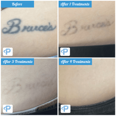 We call this one done! Our patient couldn't be happier with the result, after just four laser treatments this tattoo is flawlessly removed.