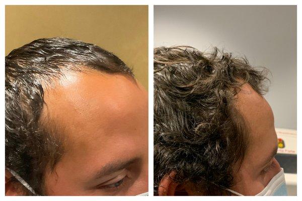 Hair Loss treatments with PRP does work. Here is some great results just after 3 treatments.