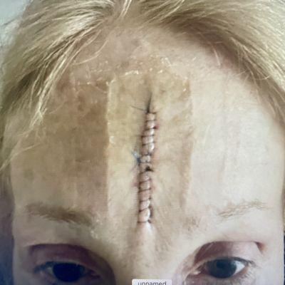 Dr.Shagalov MOHs Surgery -SCAR Middle of Face