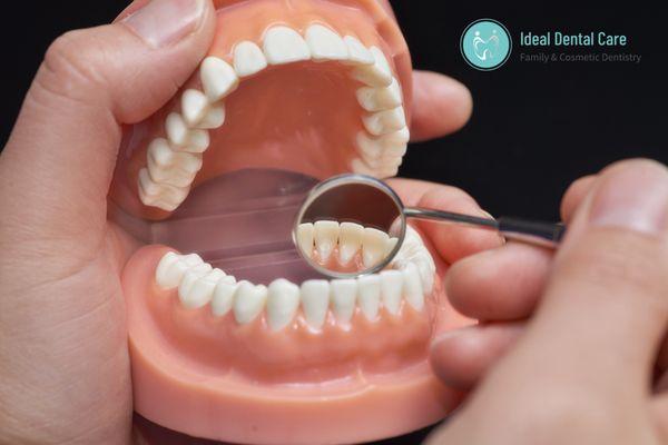 At Ideal Dental Care in San Jose, we combine preventive, restorative and cosmetic services to meet the needs of our patients.