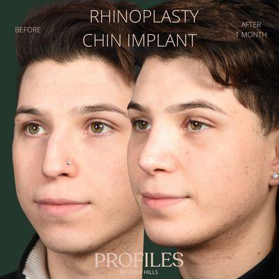 Rhinoplasty + Chin Implant