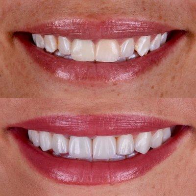 Before and after of porcelain veneers by Dr. Kasra Tajik cosmetic dentist