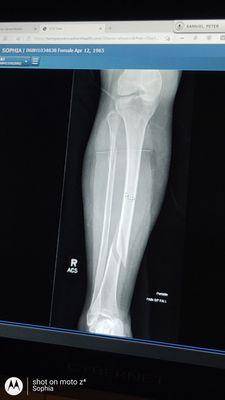 Pre-Op of my Fractured Fibia and Tibia.