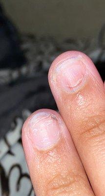 The red blood under the top of the first nail and the red irritation under the second nail at the bottom