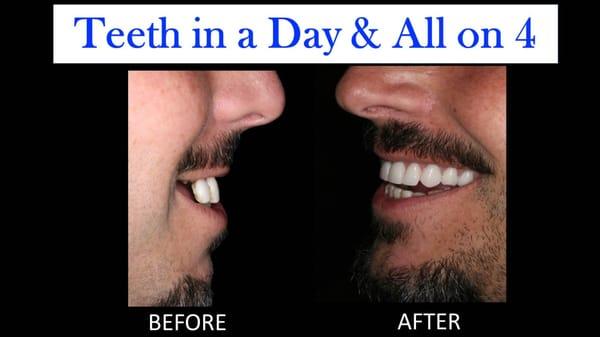 Actual patient. Teeth in a Day / All on 4 patient upper jaw only.  Before and After Results