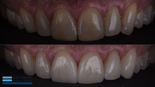 Before and after images with porcelain veneers