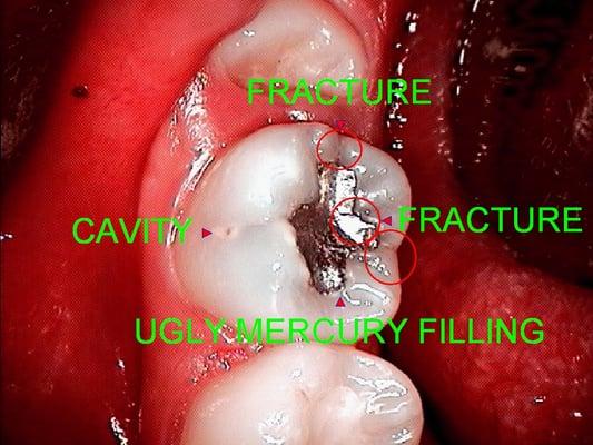 Before...Ugly "Silver" (Mercury) Filling!