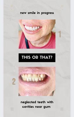 Upgrading smile with very minimal prep veneers.