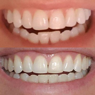 Before/after Invisalign. (1 year)