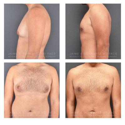 liposuction and gynecomastia