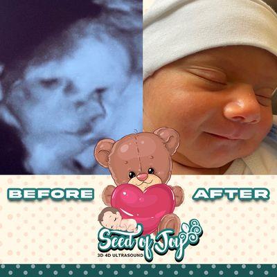 Newborn baby before and after pictures. 3D Ultrasound and 4d Ultrasound. #genderreveal