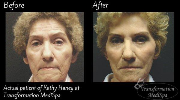 Non-surgical facelift using facial fillers and neuromodulators.