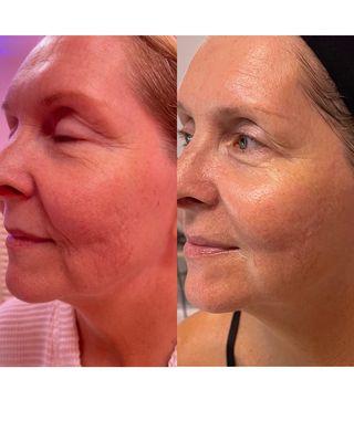 3 Advanced Plasma Treatments, 2 Age Defying Facials