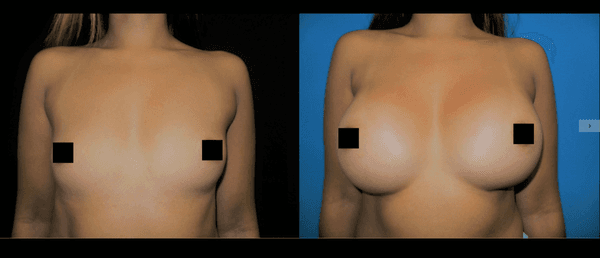 Breast Augmentation with Allergan Soft Touch Implants size 405cc, Moderate Profile