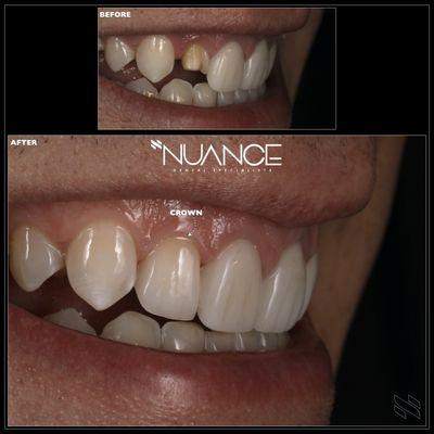 An all-ceramic crown restores strength and beauty to a fractured veneer.