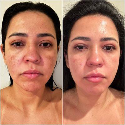 Melasma Treatment