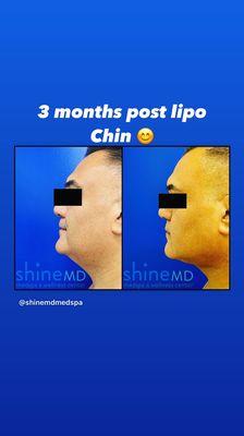 SmartLipo is the best way to fix the double chin!! Perfect jaw line with no sagging skin!!