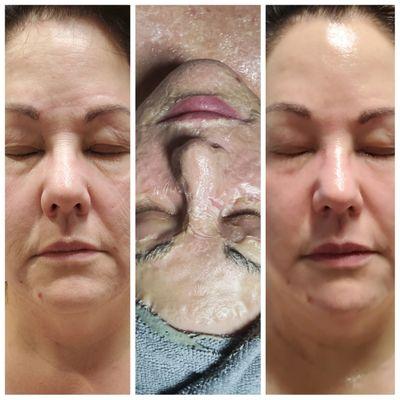 Dmk Enyzme Facial Treatment 
Before, While and After