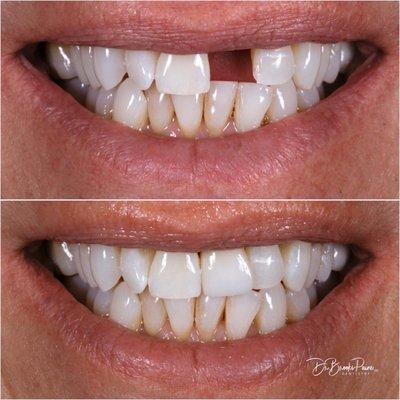 Before/After Natural Implant Crown