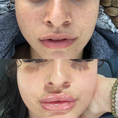 before and after 2ml of revanesse (1ml done in january, 1ml done in may)