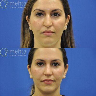 Rhinoplasty before (top) and after (bottom)