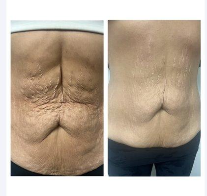 Her 4th session with body cavitation, vacuum therapy and radio frequency to tighten and firm loose skin.